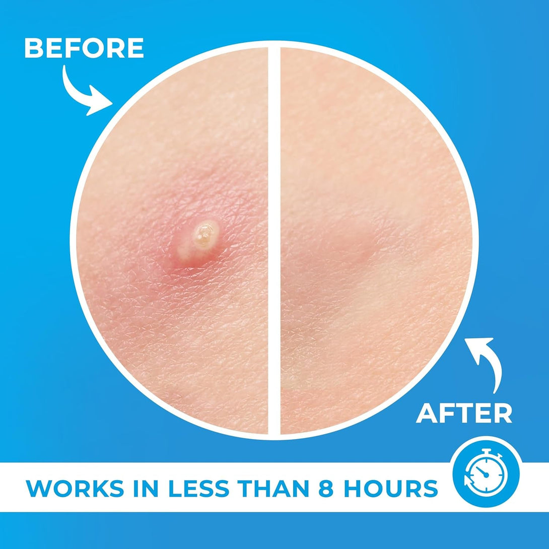 Patchrx Pimple Patches for Face (120 Patches), Hydrocolloid Acne Patches with Tea Tree Oil, Pimple Patch Pimple Stickers - Hydrocolloid Patch Acne Dots - Acne Pimple Patches for Face - Zit Patches