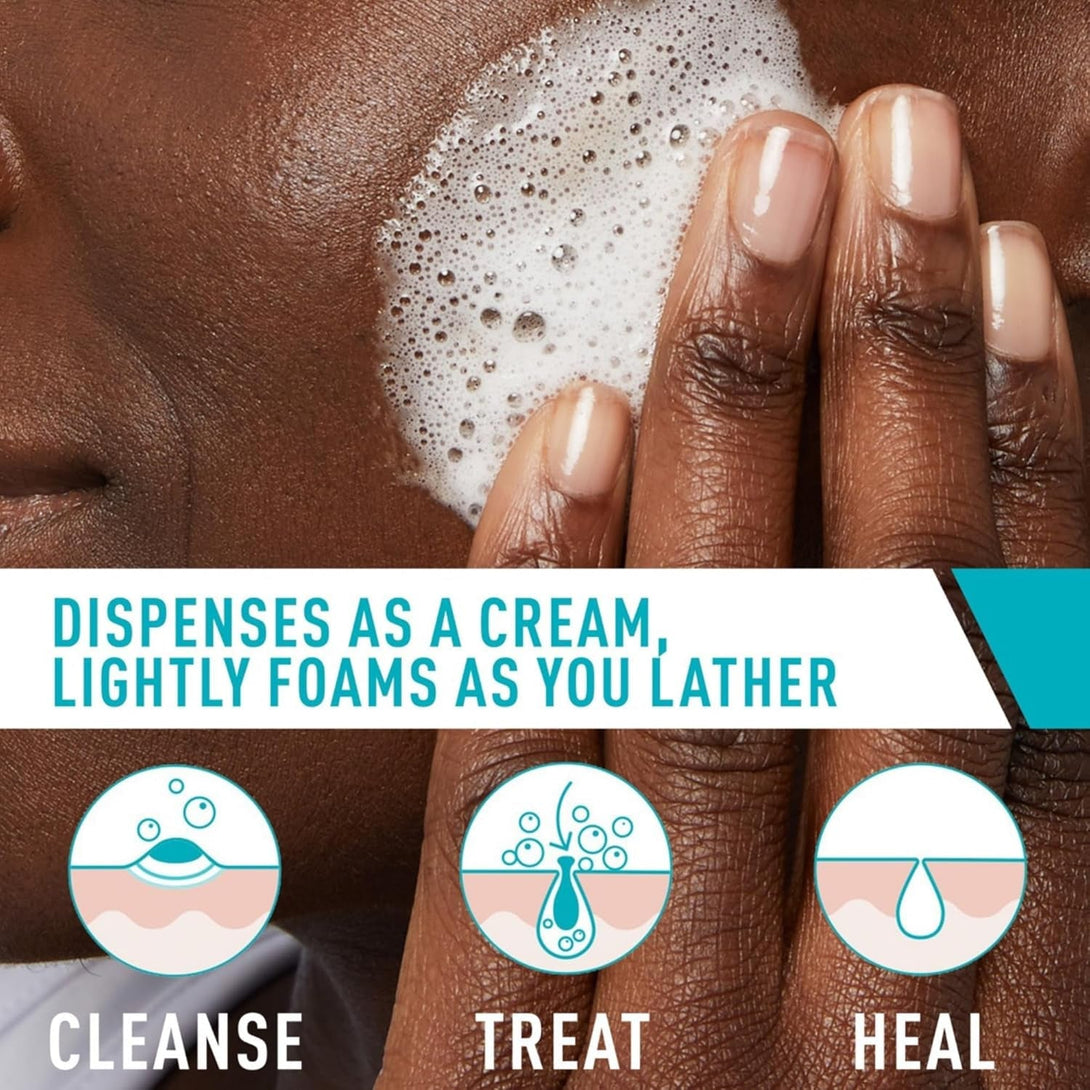 Cerave Acne Foaming Cream Cleanser, 4% Benzoyl Peroxide Face Wash with Hyaluronic Acid, Niacinamide & Ceramides, Gentle Daily Acne Treatment for Face