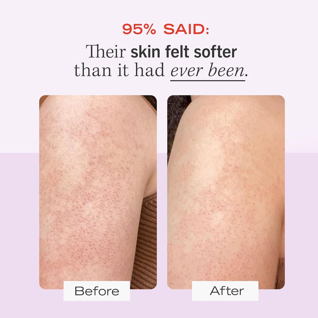 First Aid Beauty - KP Bump Eraser Body Scrub with 10% AHA, Keratosis Pilaris Skin Exfoliator with Glycolic and Lactic Acids, Helps Reduce Chicken Skin Bumps, Safe for Sensitive Skin, 2 Oz