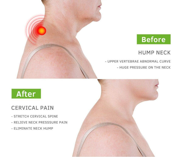 Tietze Syndrome and Costochondritis Treats Back Stretcher Posture Corrector to Relieve Headaches Chest Upper and Lower Back Pain
