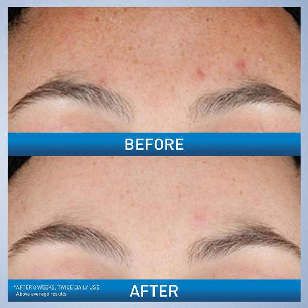 Cerave Resurfacing Retinol Serum for Post Acne Marks, Formulated with Licorice Root Extract & Niacinamide, Brightening Serum & Pore Minimizer for