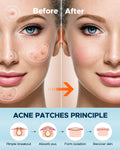 Litbear Large Acne Pimple Patches, 6 Sizes 100 Patches for Large Breakouts, Acne Patches for Face, Chin or Body, Acne Spot Treatment with Tea Tree