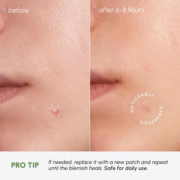 MAREE Pimple Patches for Face - Clear Acne Patches for Face - Invisible Hydrocolloid Patch Parches Para Acne Stickers Zit Dots - Cystic Zit
