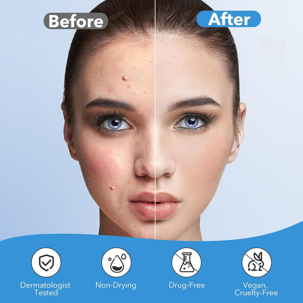 Pimple Patches for Face, Acne Patches Hydrocolloid, Cute Star Zit Covers for Face, Spot Stickers with Tea Tree, Salicylic Acid & Cica Oil|