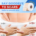 Wifamy Silicone Scar Sheets for Women: Medical Grade Scar Removal C-Section Recovery & Post-Surgery Care (1.6"X 60" Roll-1.5M)