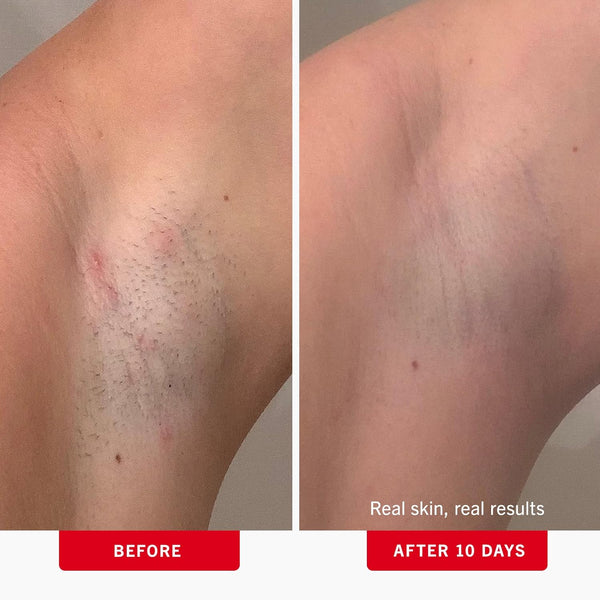 First Aid Beauty - Ingrown Hair Pads with BHA + AHA - Aftershave Treatment Pads to Help Prevent Razor Bumps for Men & Women - Exfoliate Underarms