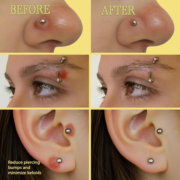 Bodyj4You Piercing Keloid Bump Removal - Natural Oil Piercing Bump Treatment - Nose Septum Belly Ear Cleaner Soothing Skin Recovery Solution -