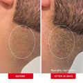 First Aid Beauty - Ingrown Hair Pads with BHA + AHA - Aftershave Treatment Pads to Help Prevent Razor Bumps for Men & Women - Exfoliate Underarms