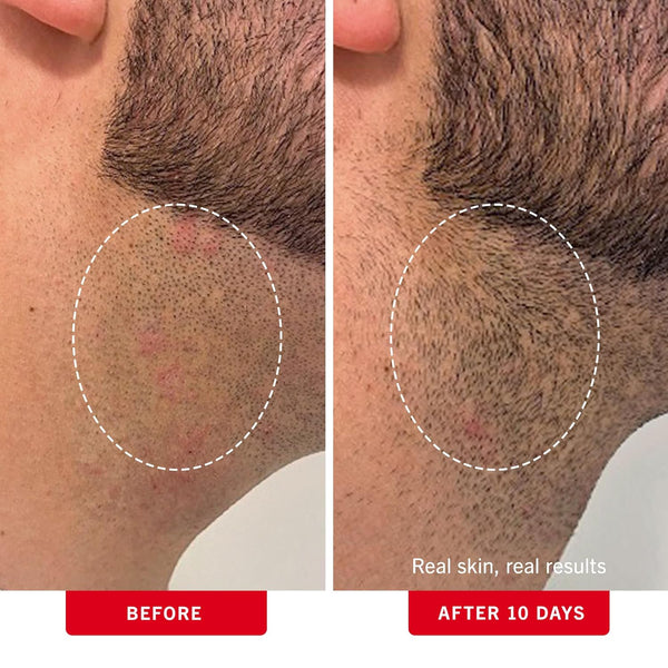 First Aid Beauty - Ingrown Hair Pads with BHA + AHA - Aftershave Treatment Pads to Help Prevent Razor Bumps for Men & Women - Exfoliate Underarms