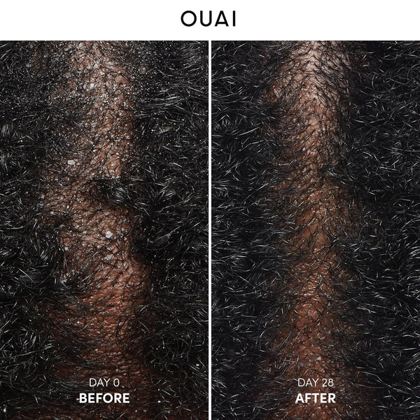 OUAI anti Dandruff Shampoo - Soothing Salicylic Acid Shampoo for Flaky, Dry and Itchy Scalp - Reduces Itching, Redness and Irritation - Sulfate