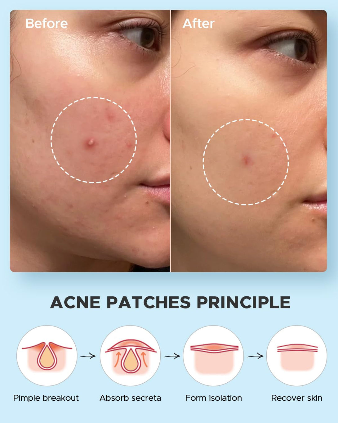 Litbear Acne Pimple Patches- Day and Night 4 Sizes 180 Dots Thin & Thick Hydrocolloid Patches with Witch Hazel, Tea Tree & Calendula Oil, Extra Adhesion for Face Zit Patch Dots