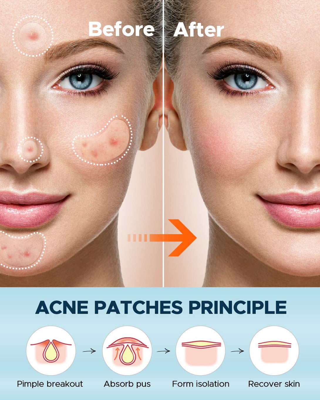 Litbear Large Acne Pimple Patches, 6 Sizes 100 Patches for Large Breakouts, Acne Patches for Face, Chin or Body, Acne Spot Treatment with Tea Tree & Calendula Oil, Hydrocolloid Bandages for Acne Skin